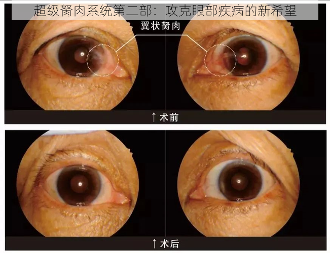 超级胬肉系统第二部：攻克眼部疾病的新希望