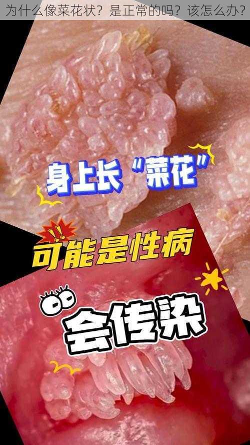 为什么像菜花状？是正常的吗？该怎么办？